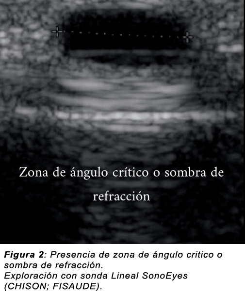 Sombra por refracción