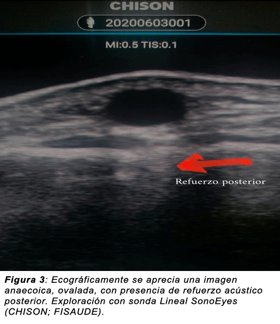 Refuerzo acústico posterior